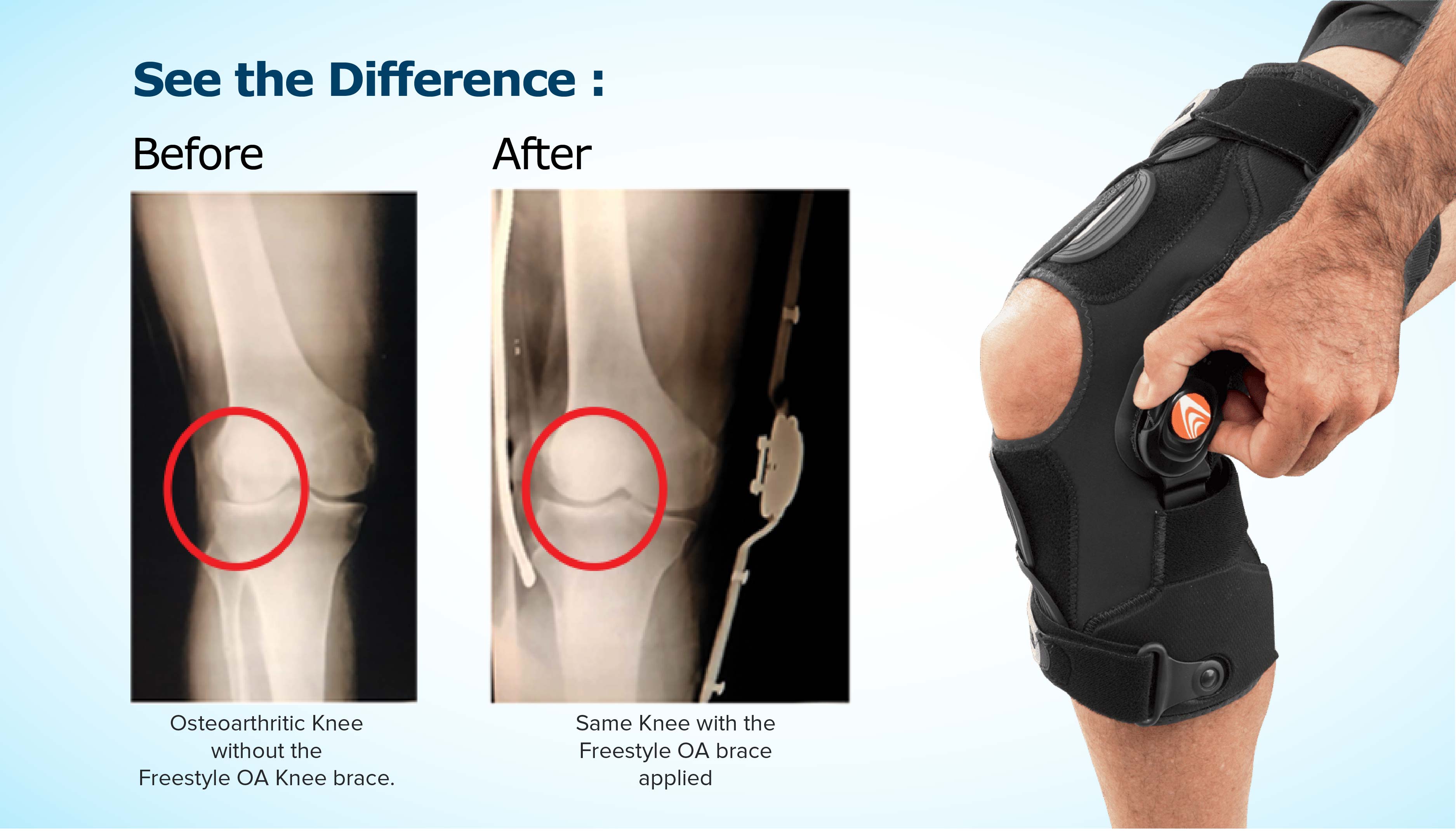 Before and After Results of OA Management